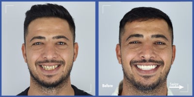 Smile Makeover before and after photo
