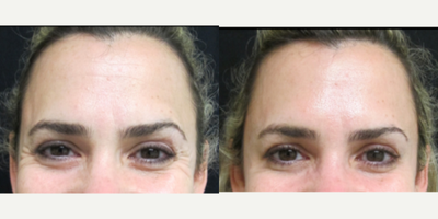 Botox before and after photo