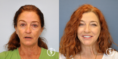 Dental Implants before and after photo