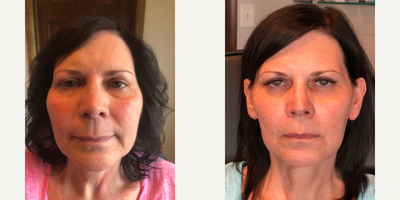 Liquid Facelift before and after photo