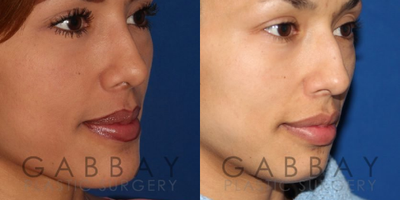 Rhinoplasty before and after photo