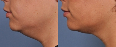 Ultherapy before and after photo
