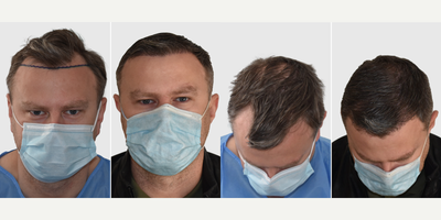 Hair Loss Treatment before and after photo