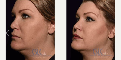 Microneedling before and after photo