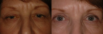 Eyelid Surgery before and after photo