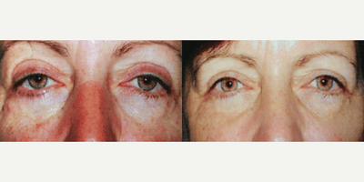 Eyelid Surgery before and after photo
