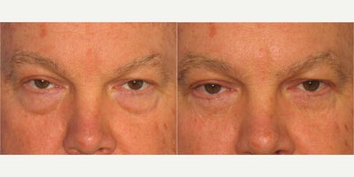 Eyelid Surgery before and after photo