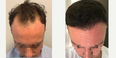 Hair Loss Treatment before and after photo