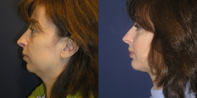 Liposuction before and after photo