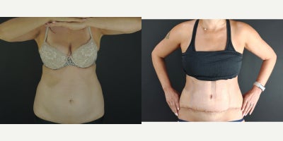 Tummy Tuck before and after photo
