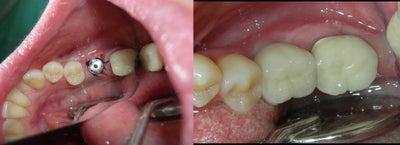Dental Implants before and after photo