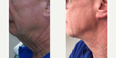 Lower Facelift before and after photo