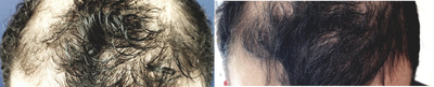PRP for Hair Loss before and after photo