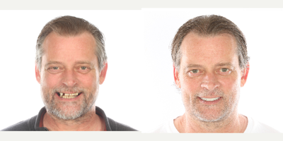 All-on-4 Dental Implants before and after photo