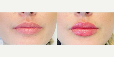 Dermal Fillers before and after photo