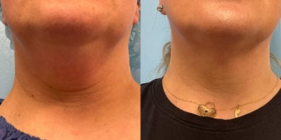 ThermiTight before and after photo
