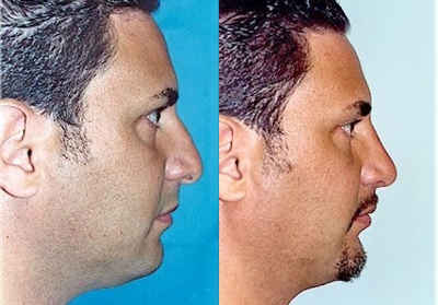 African American Rhinoplasty before and after photo
