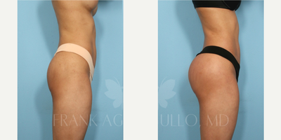 Butt Implants before and after photo
