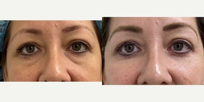 Eyelid Surgery before and after photo
