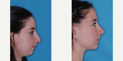 Genioplasty before and after photo