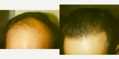 Hair Transplant before and after photo