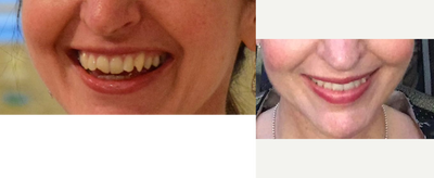 Invisalign before and after photo