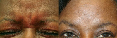Botox before and after photo