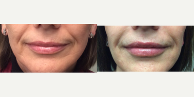 Dermal Fillers before and after photo