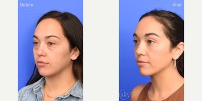 Eyelid Surgery before and after photo