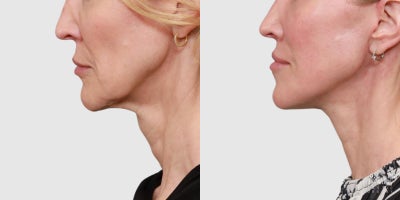 Facial Fat Transfer before and after photo