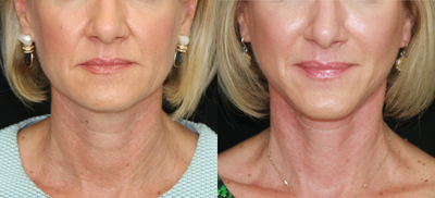 Mini Facelift before and after photo