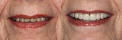 Smile Makeover before and after photo