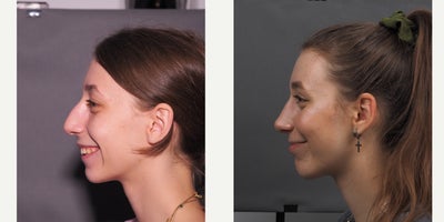 Chin Implant before and after photo