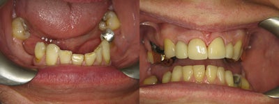 Dental Bonding before and after photo