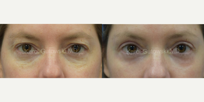 Eyelid Surgery before and after photo