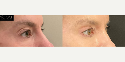Eyelid Surgery before and after photo