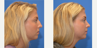 Rhinoplasty before and after photo