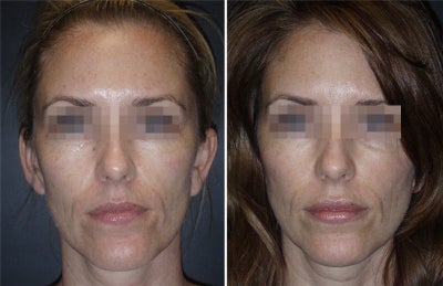 Juvederm before and after photo