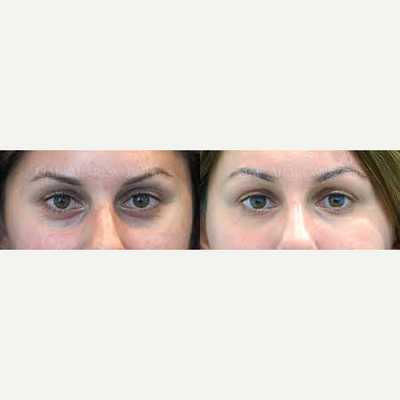 Eyelid Surgery before and after photo