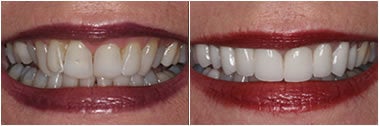 Smile Makeover before and after photo