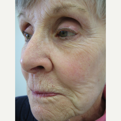 Chemical Peels Before & After Photos - Dr. Michele Green M.D.
