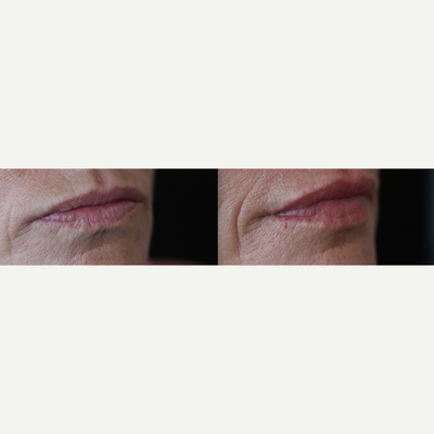 Lip Fillers before and after photo