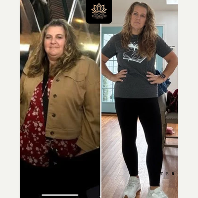 Tirzepatide for Weight Loss before and after photo
