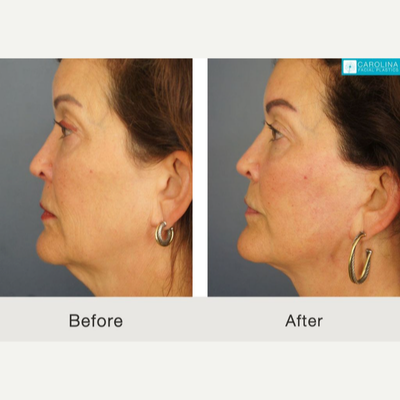 Facelift before and after photo