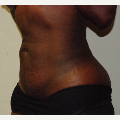 Study Confirms What Women Know: Tummy Tuck + Liposuction = Extreme  Satisfaction - Houston, Texas