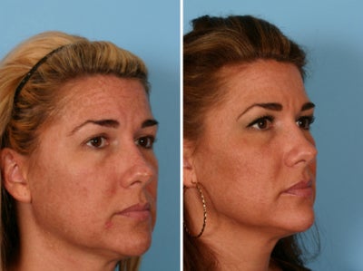 Fraxel Laser before and after photo