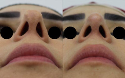 Revision Rhinoplasty before and after photo