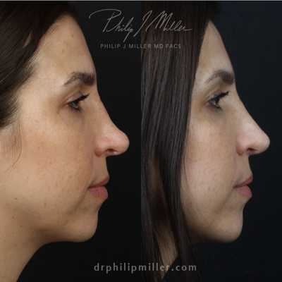 Revision Rhinoplasty before and after photo