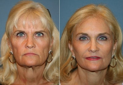 Facelift before and after photo