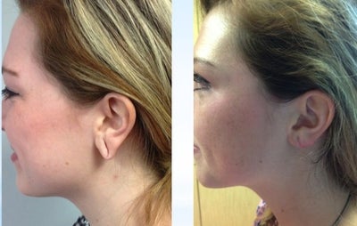 Ear Surgery before and after photo